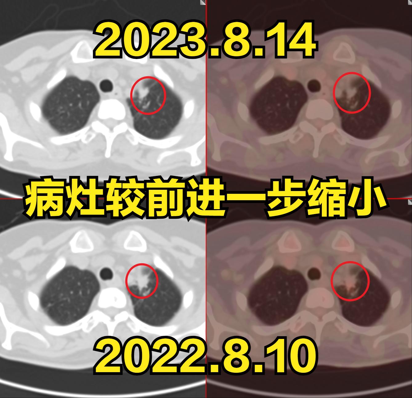 时代之光，治疗肿瘤的最新方法与希望之光探索